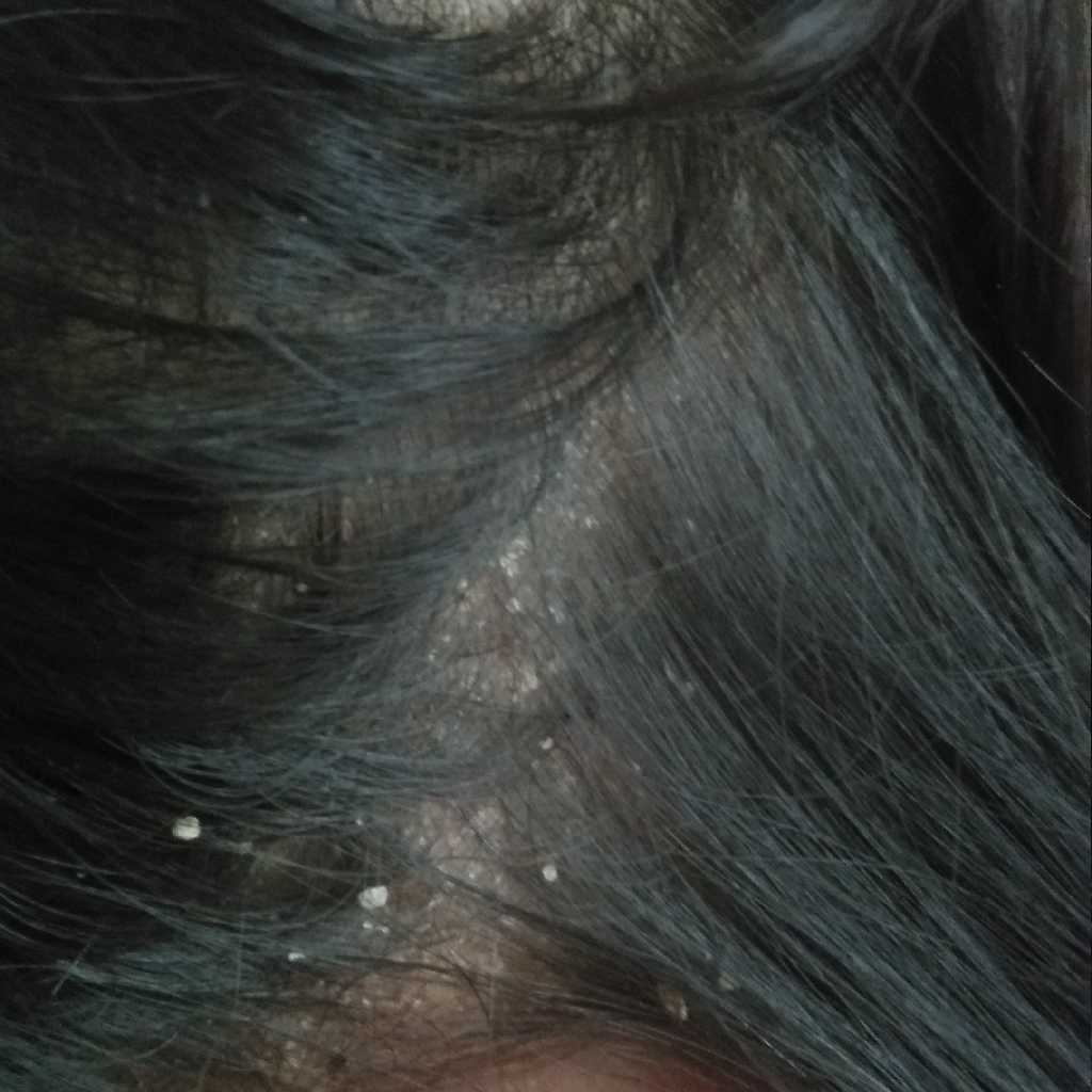 my baby is 2 years and her scalp os too dry which look like the picture i  have attatched. what is the remedy to get over from this. it is spreaded all