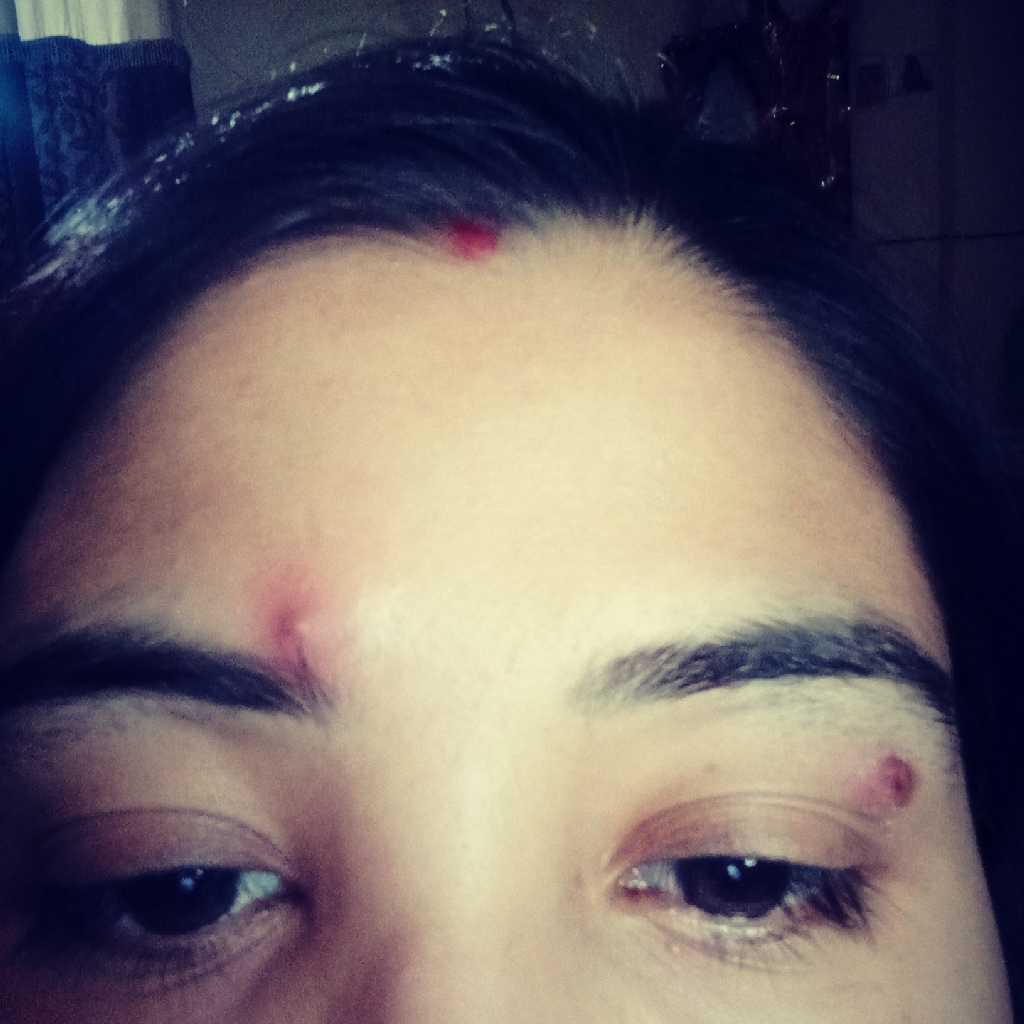 Mamypoko I M Having Pimples In My Forehead Its Very Painful Only Two Big Pimples Are There I Think Its Due To Heat Of Medicine I M Taking Regularly For Utrine Fibroid