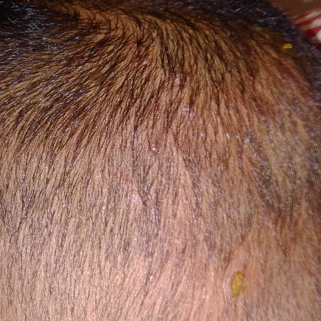 One Yr 2 Month Baby Having Heat Boils On Head It Spreading Day By Day