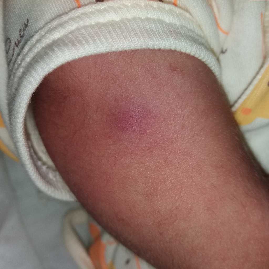 Hello Doctor My 1month Old Baby Has Got A Painless Hard Lump On The Bcg Vaccinated Arm Is This Something To Be Worried Firstcry Parenting